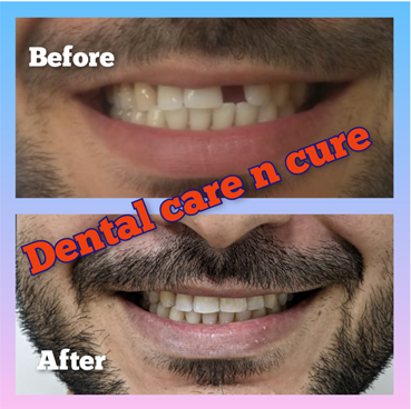 Dental implants in Pachim Vihar Dental implants in Pachim Vihar